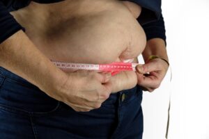 La nuova chirurgia bariatrica senza tagli che sta sostituendo il bypass classico